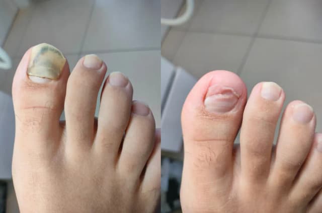 Jak długo boli zbity paznokieć? Sprawdź, co musisz wiedzieć Jak długo boli zbity paznokieć? Sprawdź, co musisz wiedzieć