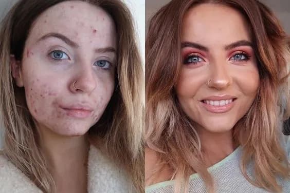 Jak poprawić stan cery trądzikowej - skuteczne metody na piękną skórę Jak poprawić stan cery trądzikowej - skuteczne metody na piękną skórę