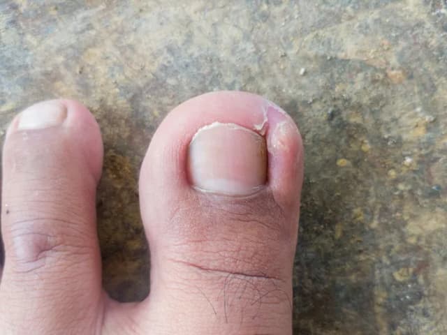 Jak wygląda wrośnięty paznokieć? Objawy i skutki, które musisz znać Jak wygląda wrośnięty paznokieć? Objawy i skutki, które musisz znać